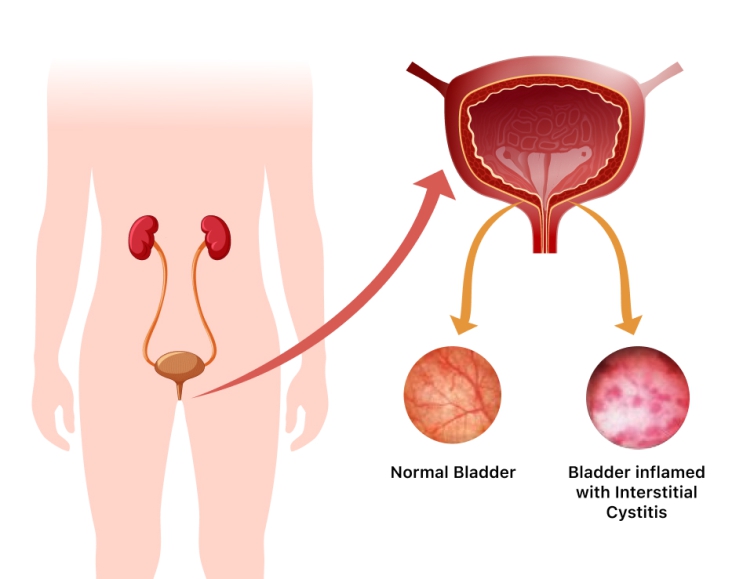 https://www.drshyamvarma.com/public/assets/img/blog/painfulbladder3