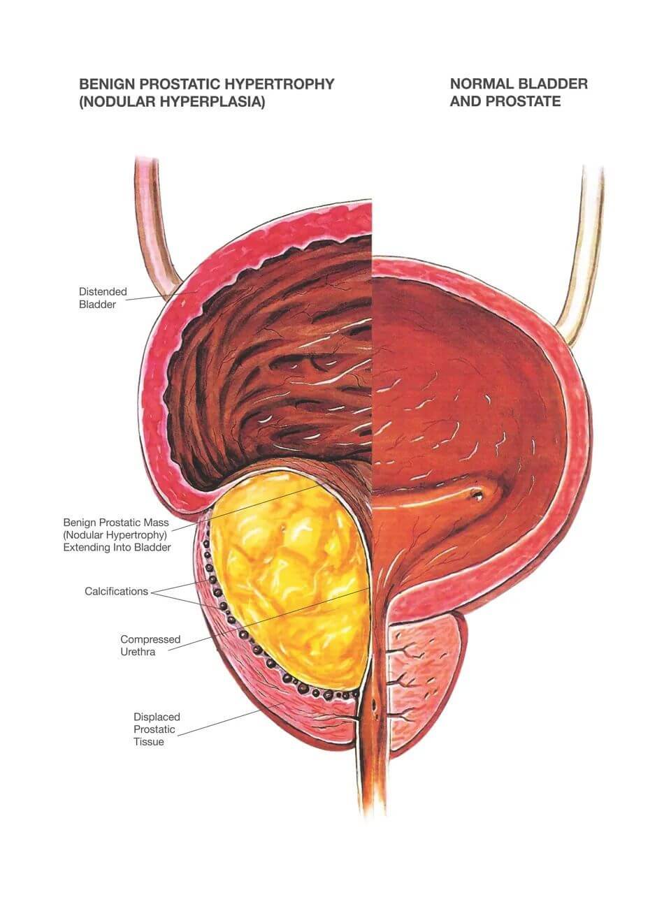 https://www.drshyamvarma.com/public/assets/img/blog/prostate-enlargement/blog2